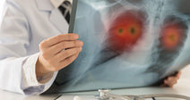 Lung Cancer in Nonsmokers: Rising Among Women and Younger Adults