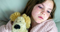 A young girl with a red spotted rash lies resting in bed, wrapped in a pink blanket and hugging a stuffed animal toy.
